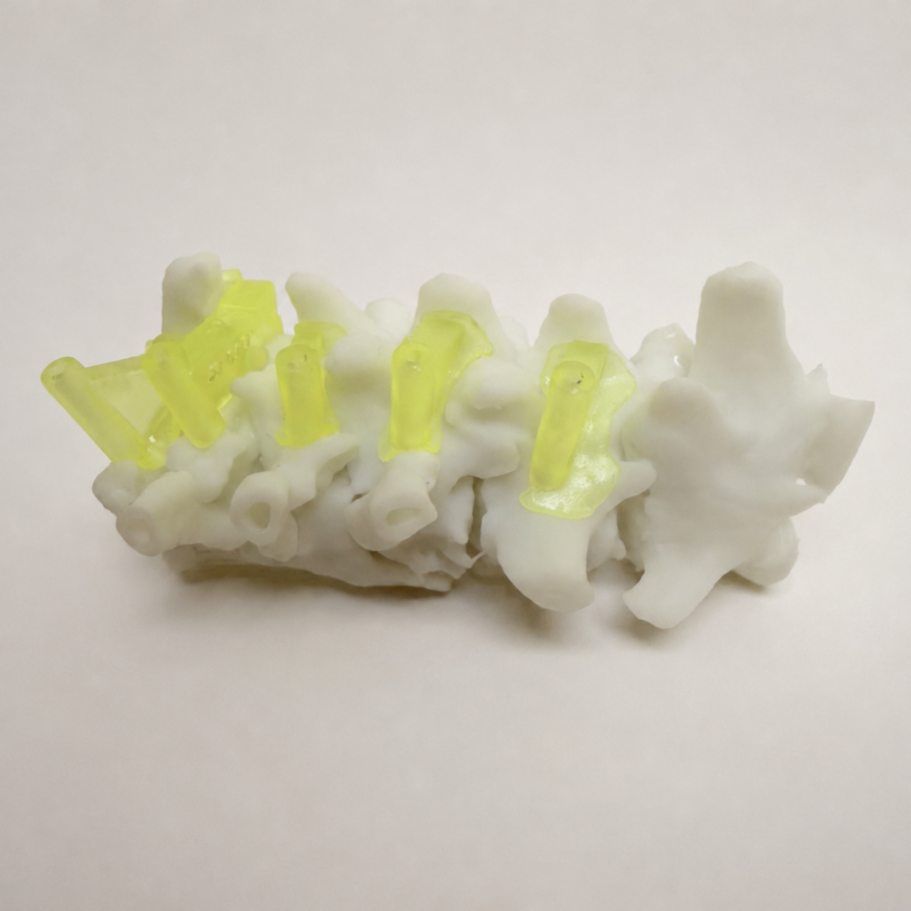 Spinal stabilisation for vertebral malformations