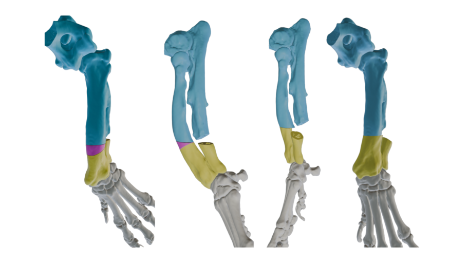 Antebrachial growth deformity planning