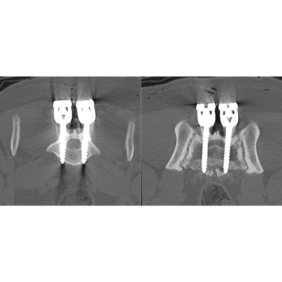 Lumbosacral stabilisation - post-op CT