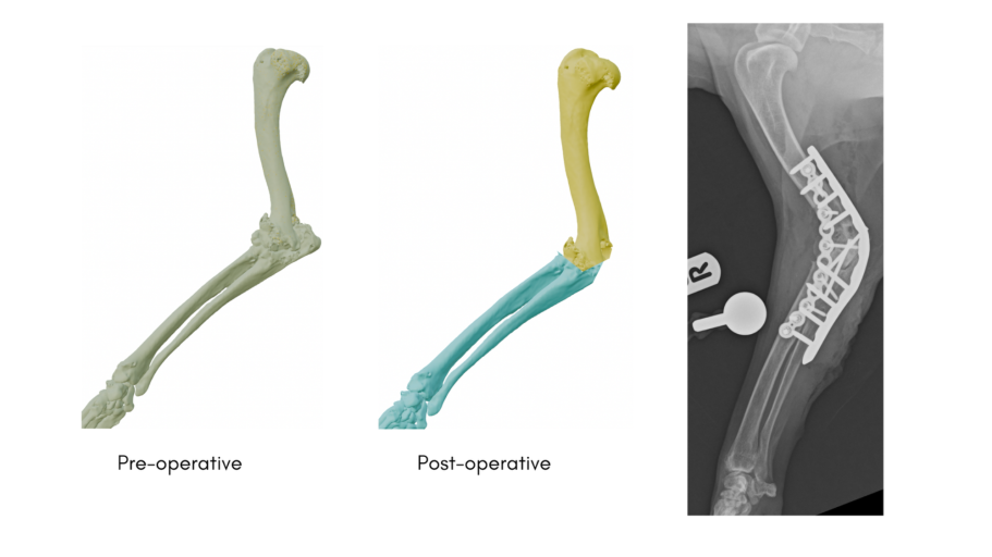 Elbow arthrodesis