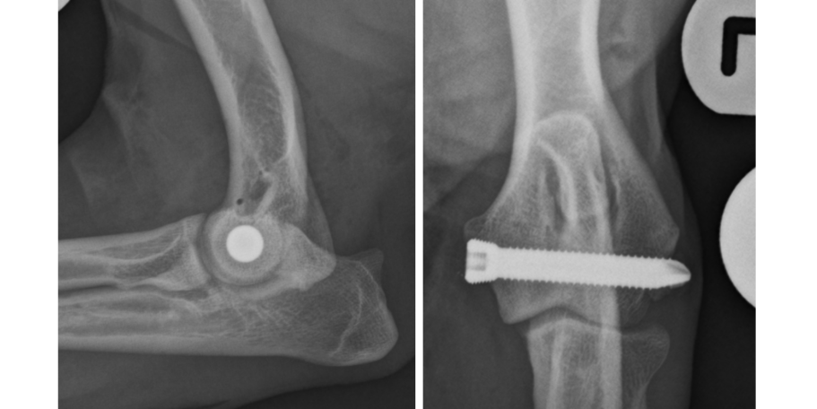 Transcondylar screw - post-op radiographs