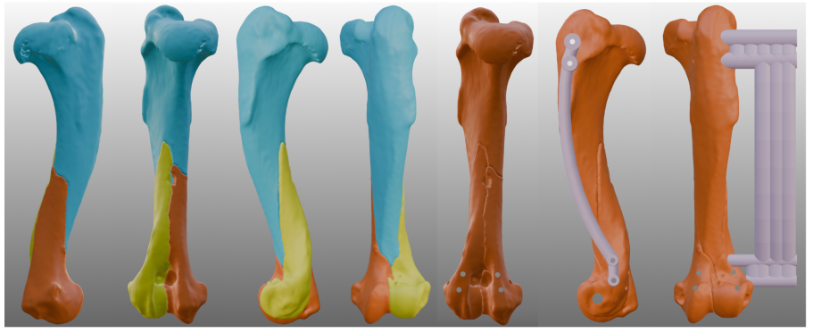 Bone fracture planning